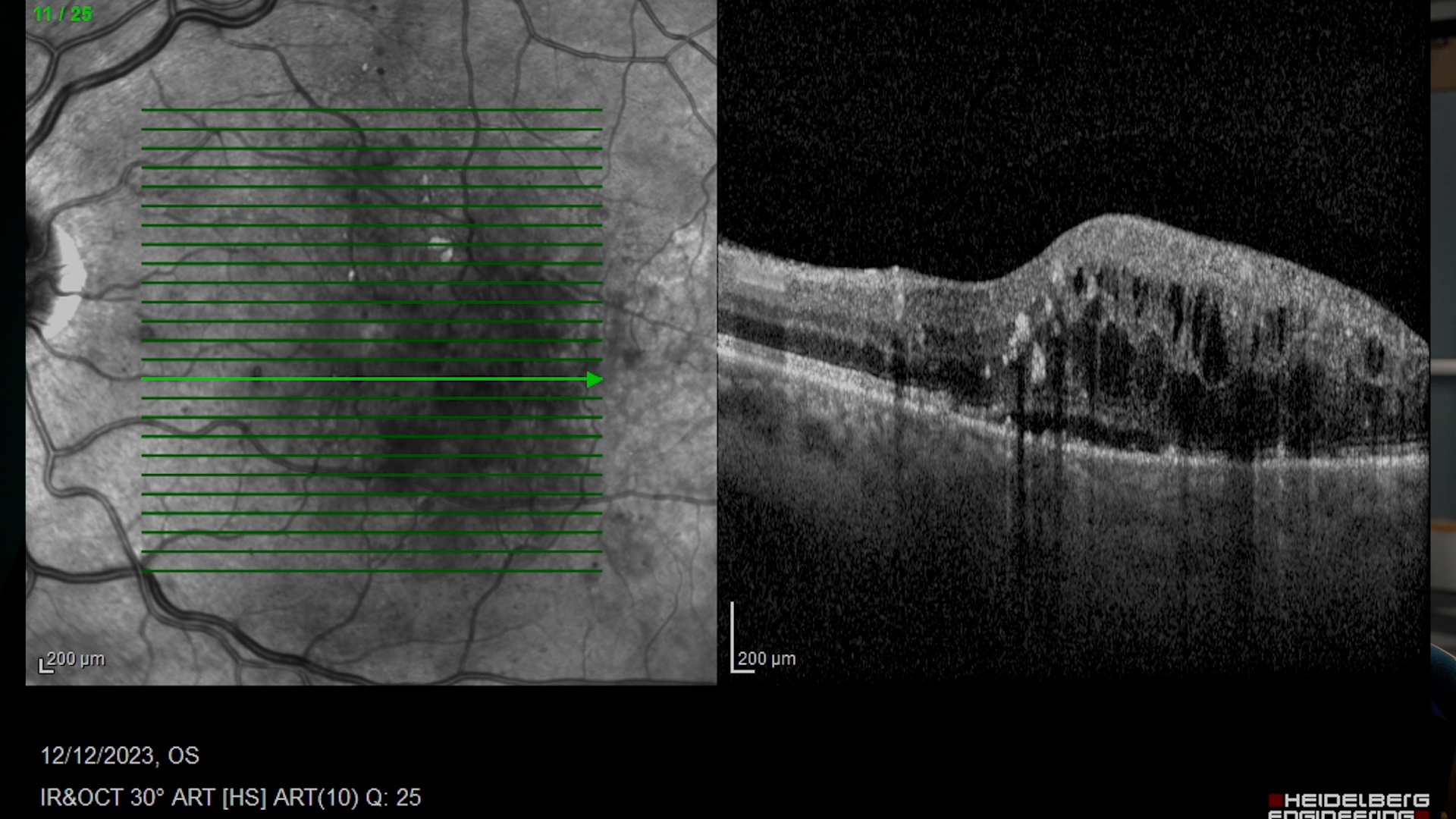 Split-screen medical image shows a cross-section of eye tissue on the right and scanning lines on the left. Date: 12/12/2023.